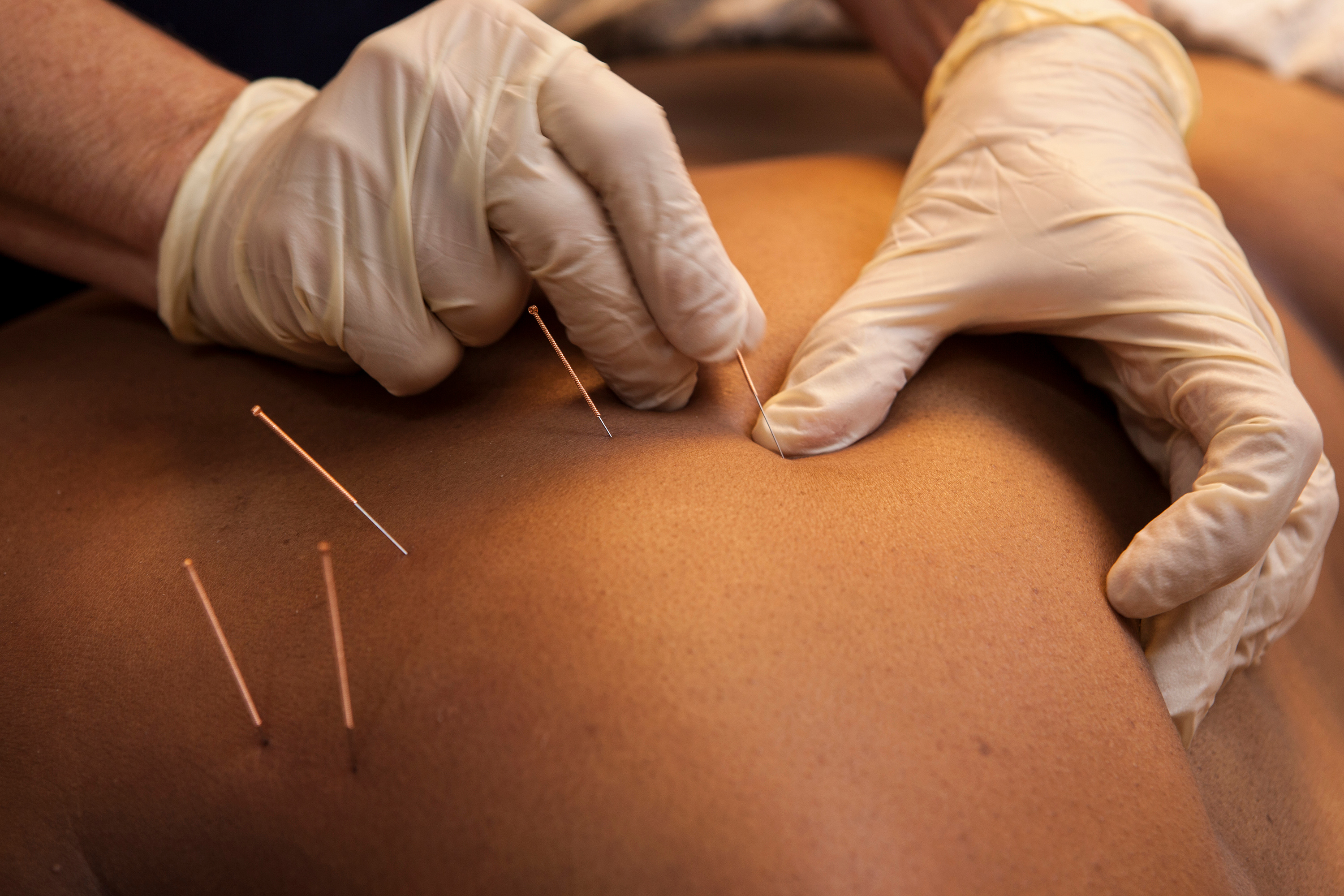Customised Sessions - Dry Needling and Cupping